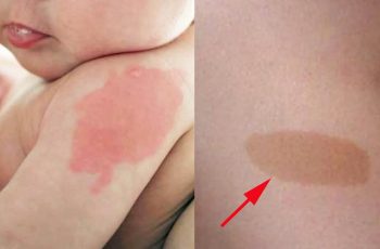 Đứa trẻ nào khi sinh ra hầu như đều có bớt trên người, nhưng nếu xuất hiện ở 10 vị trí sau báo hiệu số kiếp giàu sang