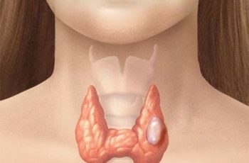 Số lượng u tuyến giáp ngày càng tăng nhanh, bác sĩ khuyên nên ăn ít hơn loại thực phẩm này Số lượng u tuyến giáp ngày càng tăng nhanh, bác sĩ khuyên nên ăn ít hơn loại thực phẩm này