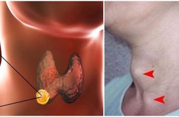 7 triệu chứng rõ mồn một của UT tuyến giáp, nhiều người ở giai đoạn nặng vẫn không biết 7 triệu chứng rõ mồn một của UT tuyến giáp, nhiều người ở giai đoạn nặng vẫn không biết