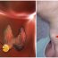 7 triệu chứng rõ mồn một của UT tuyến giáp, nhiều người ở giai đoạn nặng vẫn không biết