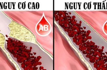 Nếu mang trong người nhóm máu O, bạn nhất định phải biết điều này để giữ lấy mạng sống của mình Nếu mang trong người nhóm máu O, bạn nhất định phải biết điều này để giữ lấy mạng sống của mình