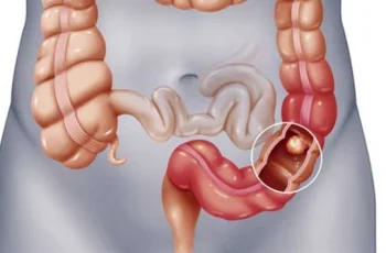 Cảnh báo dấu hiệu khi đi ngoài chứng tỏ cơ thể đã bị ung thư đại tràng, cần đi khám gấp