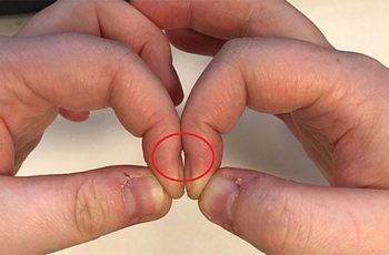 Đặt 2 đầu ngón tay trỏ sát nhau, đoán ngay mình có bị ung thư phổi hay không