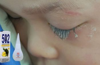 Bé trai 3 tuổi bị keo 502 bắn vào mắt, hành động của người mẹ trong “30 giây vàng” đã cứu con khỏi cảnh mù loà!