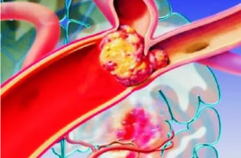 Sáng thức dậy gặp 6 dấu hiệu này, coi chừng “đột quỵ”