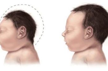 ‘Sát thủ’ gây teo não ở trẻ mà bố mẹ vẫn cho con ăn hàng ngày mà không lường trước hậu quả