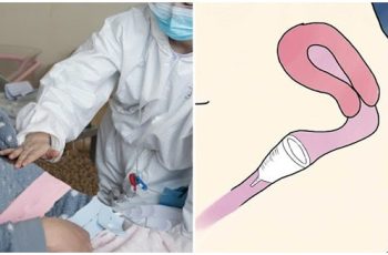 Cô gái suy kiệt vì ‘chiếc cốc’ nằm im 7 tháng, đi viện không lấy được: Cảnh báo cho chị em