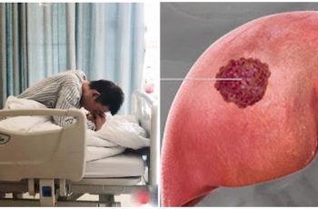 Bệnh nhân qua đời sau 60 ngày phát hiện UT gan, BS khẩn cầu: Đừng ăn 2 món hủy diệt gan nữa