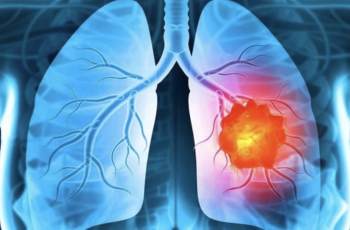 Bác sĩ chỉ ra 5 dấu hiệu cảnh báo ung thư phổi dễ bị phớt lờ