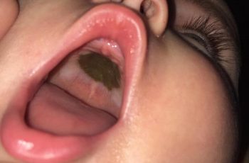 Mẹ phát hoảng thấy miệng con xuất hiện đốm đen lạ, đến bệnh viện nghe bác sĩ chúc mừng mà xấu hổ