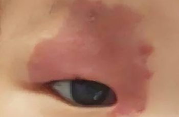 3 hành vi khi mang thai có thể gây ra vết bớt cho con, mẹ cố gắng tránh để con khỏi mặc cảm 3 hành vi khi mang thai có thể gây ra vết bớt cho con, mẹ cố gắng tránh để con khỏi mặc cảm