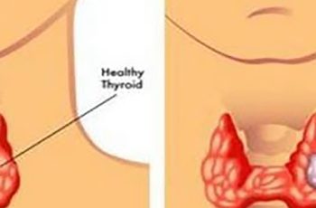 Trước khi ung thư vòm họng ‘ghé thăm’, cơ thể sẽ xuất hiện 4 vấn đề này nhưng đáng tiếc nhiều người lại bỏ qua